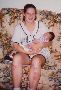  Bonnie Jean Feldkamp holding her niece Kate in 1996. Bonnie has psoriasis and psoriatic arthritis. 